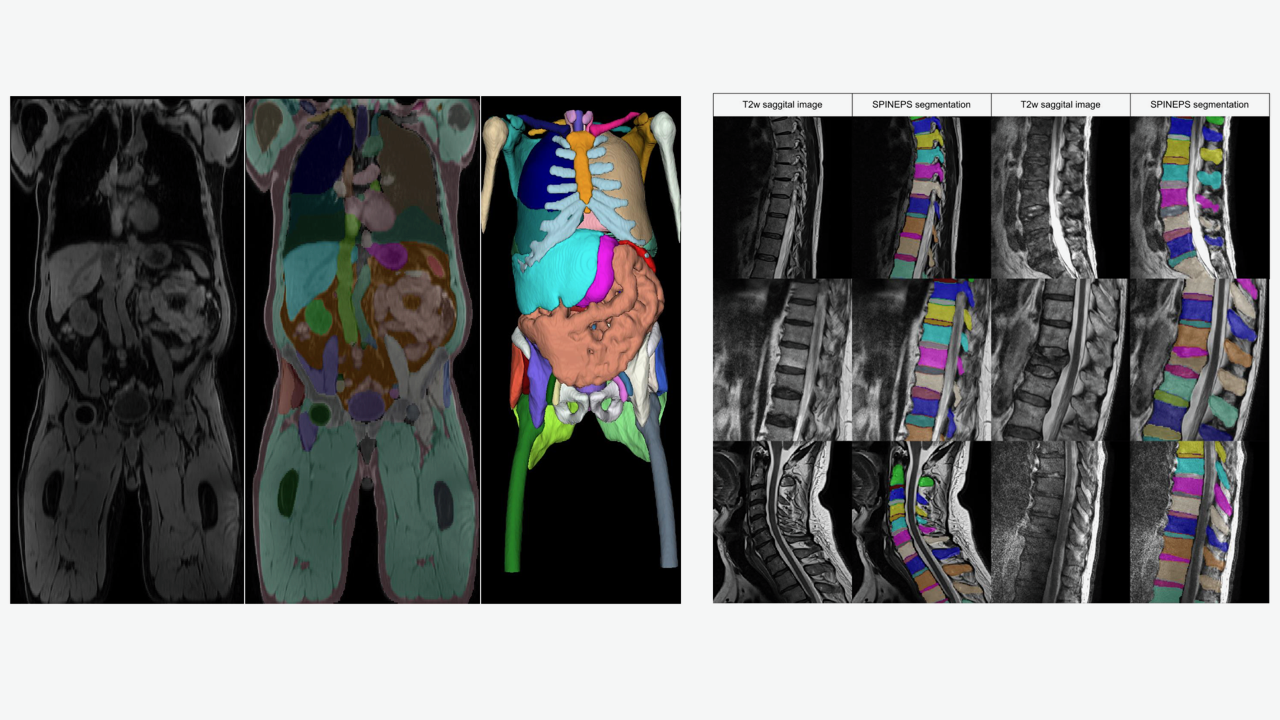 © One of the main focuses of our research is the use of deep learning approaches for the segmentation of biomedical images (e.g. left: whole body segmentation, right: spine segmentation from MR images) ©