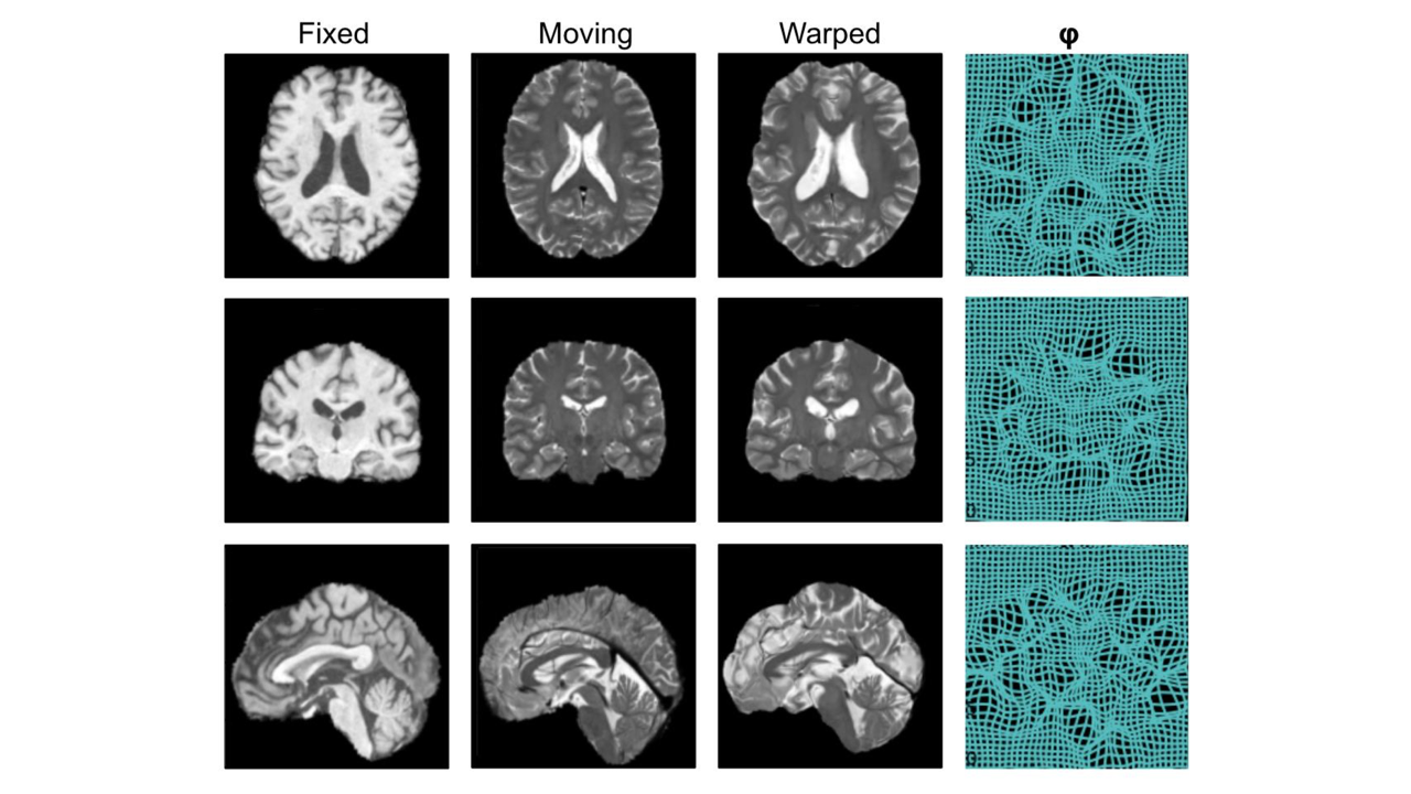 © Image registration is an essential task in medical image analysis. One of our research directions are exploring the use of ML for accurate, robust and efficient image registration. Here for example a pair of T1-weighted and T2-weighted brain MR images being registered using implicit neural representation of deformation. ©